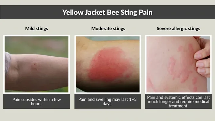 Dream Of A Bee Sting Meaning What Your Subconscious Reveals