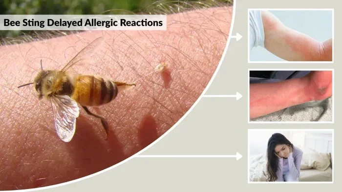 Dream Of A Bee Sting Meaning What Your Subconscious Reveals