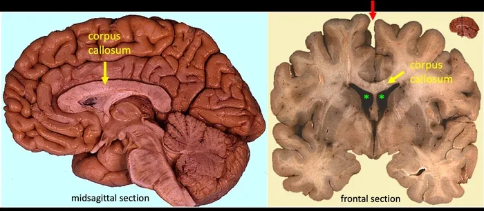 What Connects The Two Hemispheres Of The Brain Explained