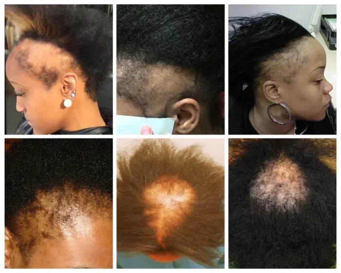 Dream Of Losing Hair Meaning What Your Subconscious Is Telling You