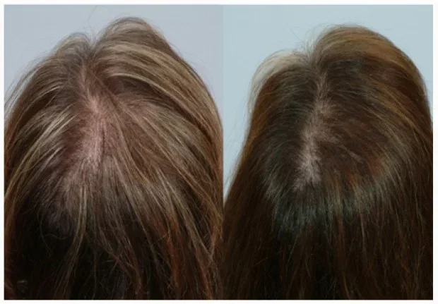 Dream Of Losing Hair Meaning What Your Subconscious Is Telling You