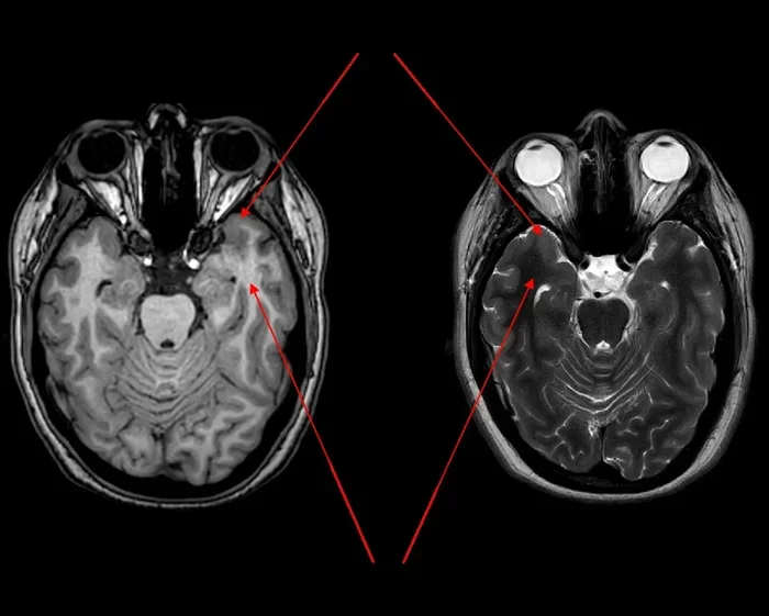 What Is White Matter In The Brain And Why It Matters